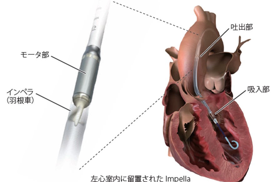 左心室内に留置されたImpella